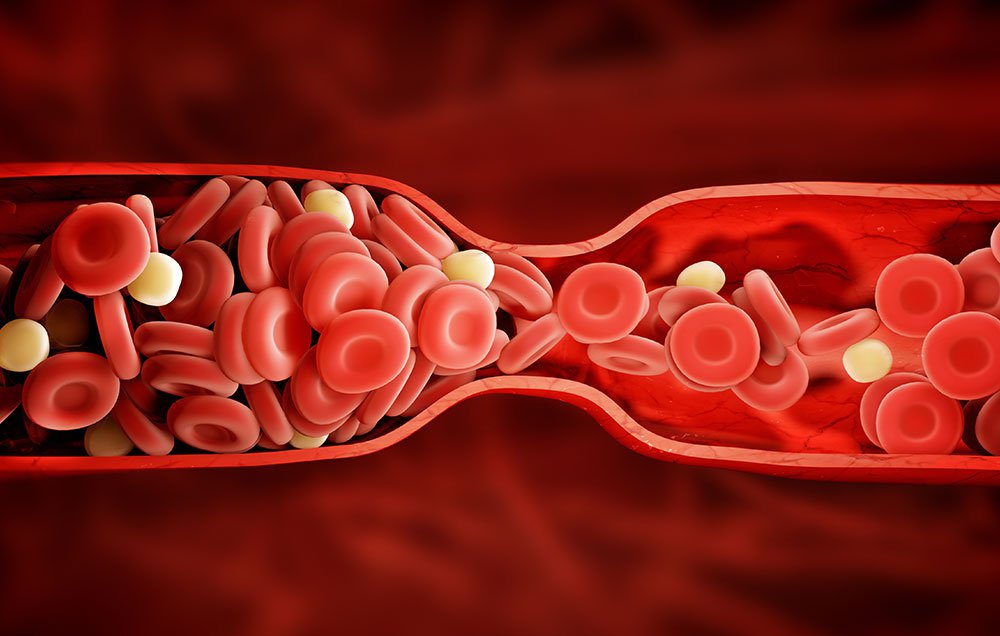 6 Anzeichen für Blutgerinsel und Thrombose, die du kennen solltest.