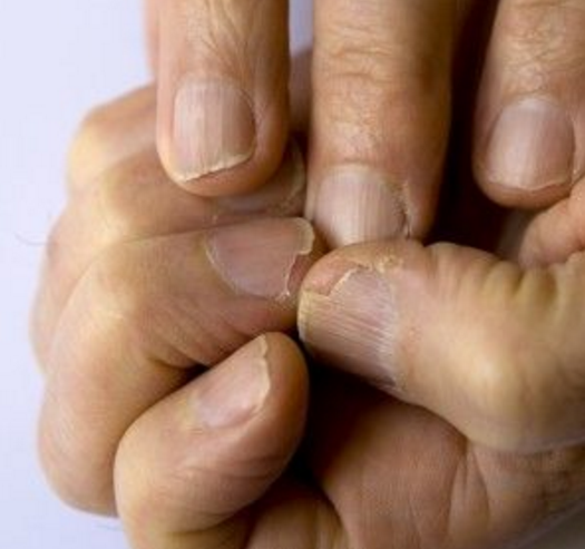 Sieh dir deine Nägel an und du erfährst, ob du Diabetes, Leberprobleme oder anderes hast. Diese 5 Symptome sind relevant.