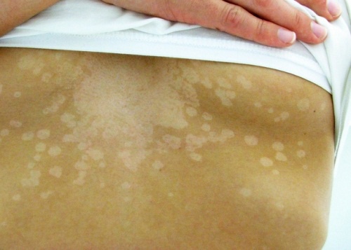 5 Signale der Haut, die auf ein Gesundheitsproblem hinweisen