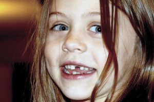 Zahngesundheit trotz Zahnlücke nur als Kind