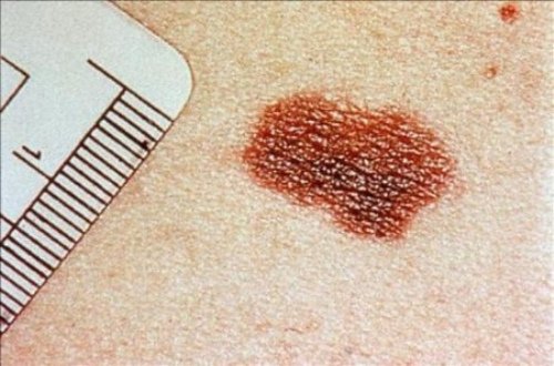 Die häufigsten Erkrankungen der Haut  