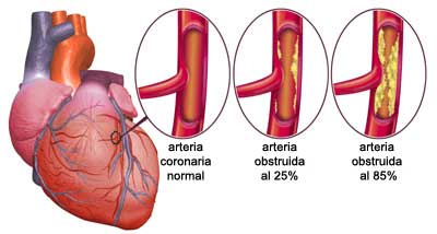 Symptome der wichtigsten Herzerkrankungen bei Frauen  