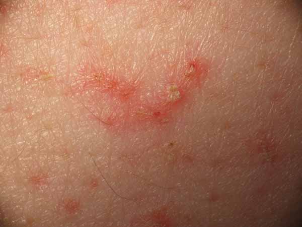 Die häufigsten Erkrankungen der Haut 