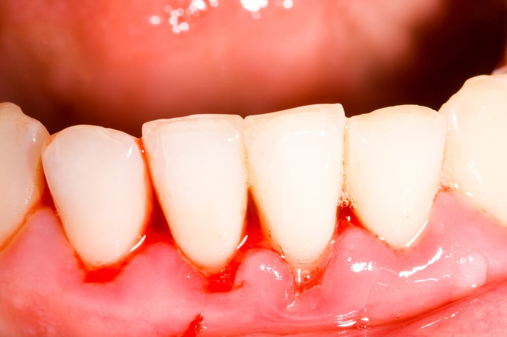 Gingivitis oder Zahnfleischentzündung 