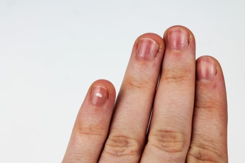 Das sagen deine Fingernägel über deine Gesundheit aus - Hogmag