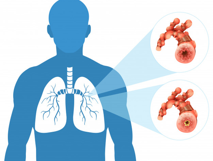 5 Frühwarnzeichen, dass Sie Lungenkrebs haben könnten - Hogmag